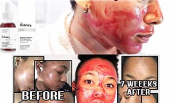 Read more about the article THE ORDINARY AHA 30% + BHA 2% PEELING SOLUTION 30ML